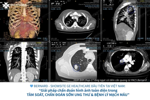 Phát hiện u phổi dù không có triệu chứng nhờ khám sức khỏe định kỳ tại Bernard Healthcare